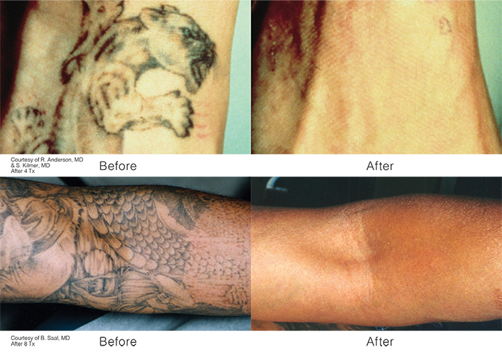 TattooRemoval-Revlite-before and after-01-01-01